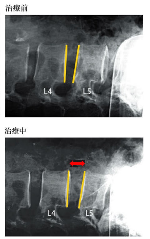 腰椎・骨盤牽引の効果を表したレントゲン写真