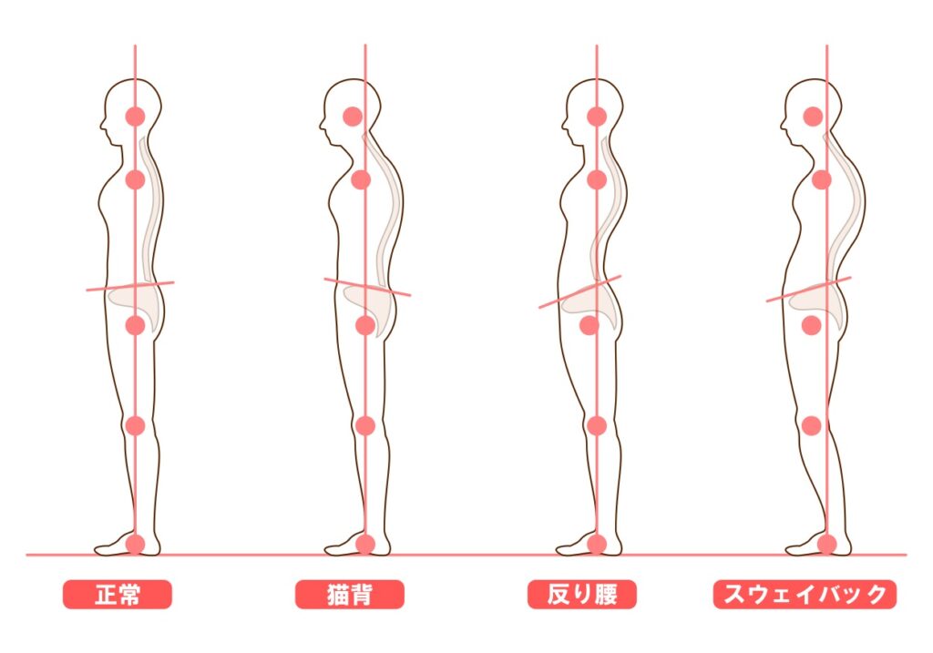 不良姿勢のイラスト図、猫背、反り腰、スウェイバック