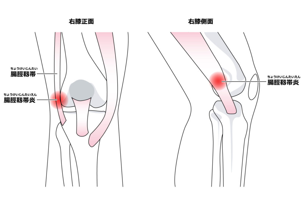 ランナー膝のイラスト図
