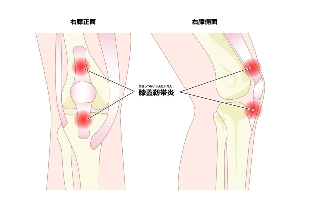 膝蓋靭帯炎を説明したイラスト図