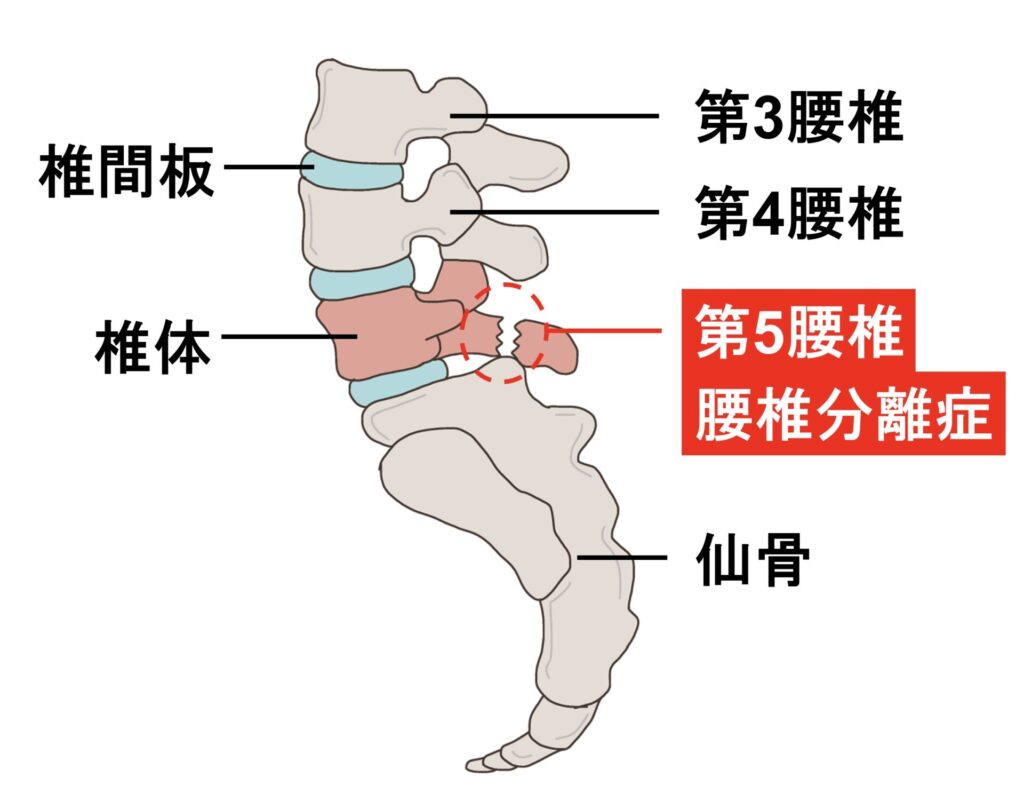 腰椎分離症のイラスト図