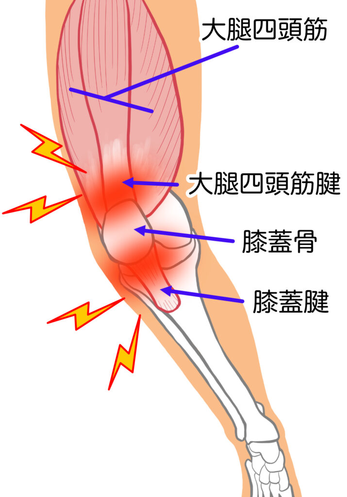 ジャンパー膝（膝蓋腱炎）のイラスト