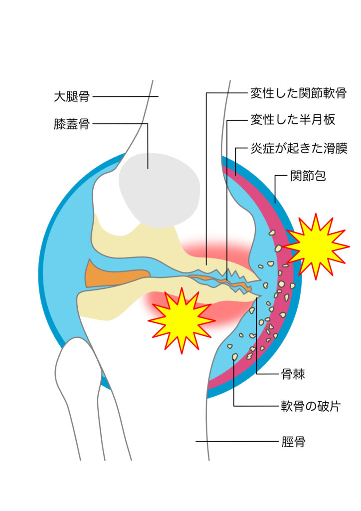 変形性膝関節症を説明したイラスト図②