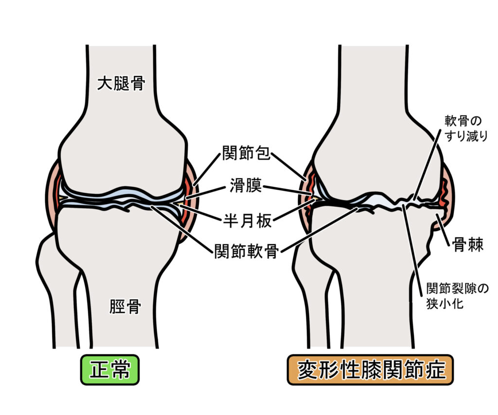 変形性膝関節症を説明したイラスト図①