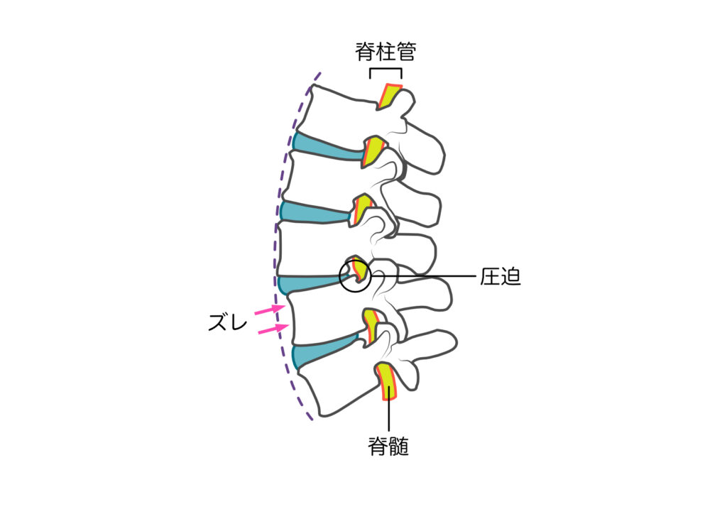腰椎分離すべり症のイラスト図