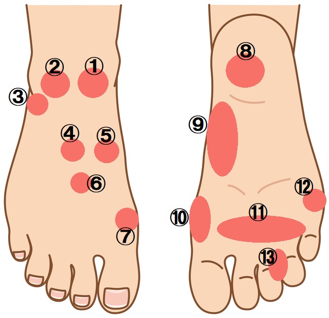 足の痛みのポイントと疾患名を明記したイラスト画像