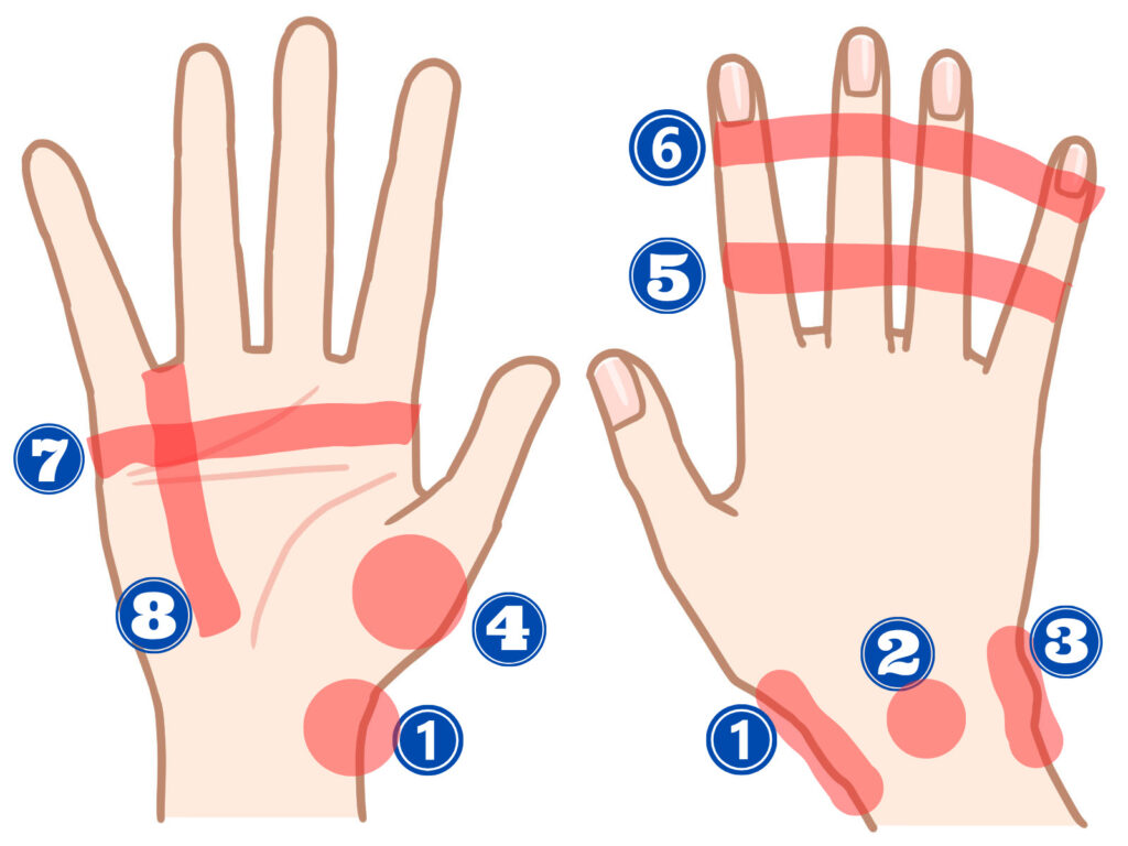 手首から指先までの痛みのポイントと疾患名を明記したイラスト画像