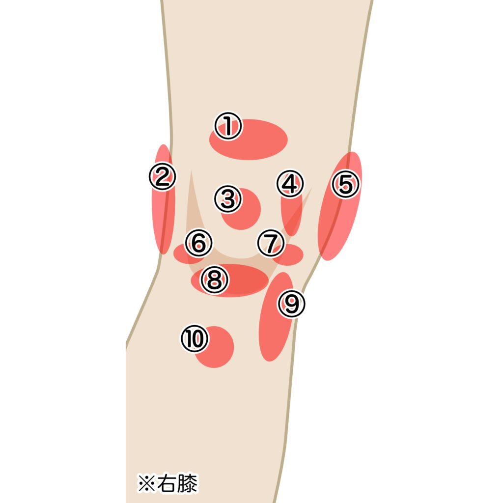 ひざ関節の痛みのポイントと疾患名を記載したイラスト