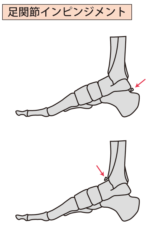 足のインピンジメント症候群のイラスト